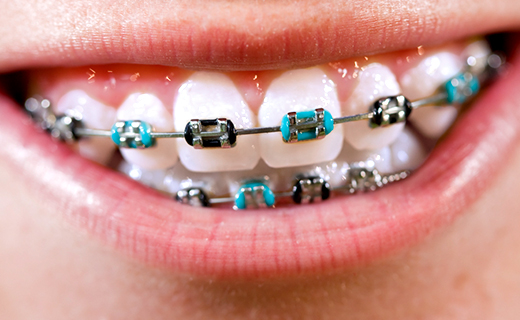 Easy Steps for Maintaining Your Braces | Affordable Braces Rockledge